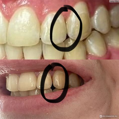 Ретейнеры - «Две проволки во рту, создавшие мне кучу проблем 😬 Полтора ...