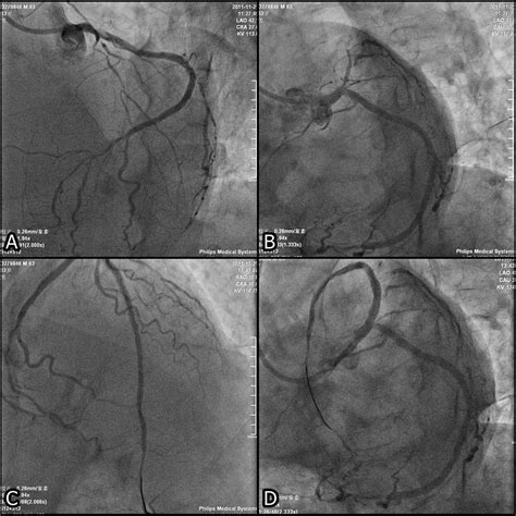 Comparison of coronary angiography-assisted and computed coronary