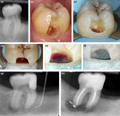 Management of deep caries and the exposed pulp - Bjørndal - 2019 ...