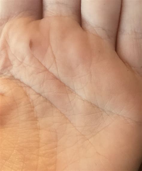 I have this birthmark in my hand. : r/Birthmark