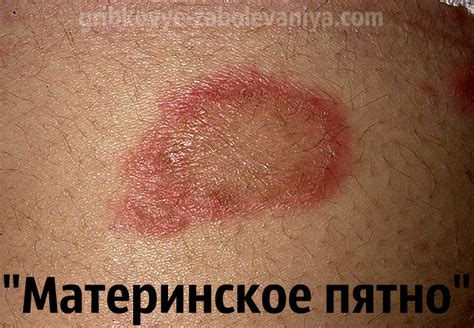 Розовый лишай Жибера: причины, симптомы, лечение, фото