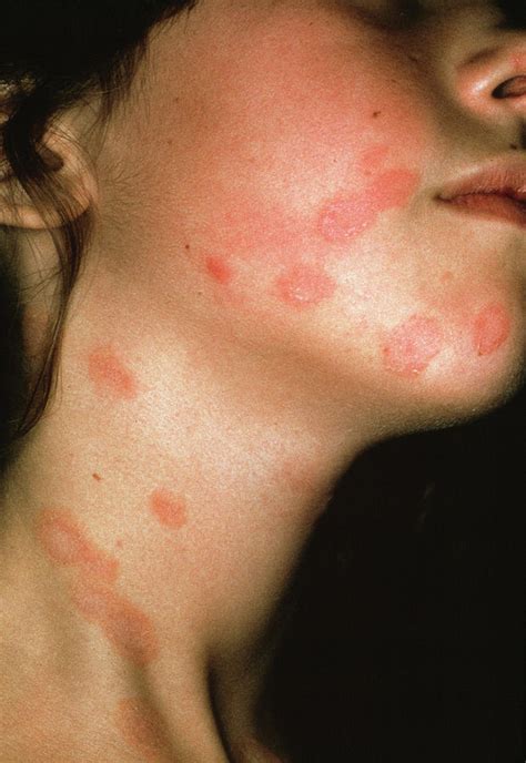 Ringworm Photograph by Cnri/science Photo Library - Pixels Merch