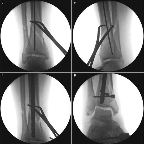distal tibia musculoskeletal key