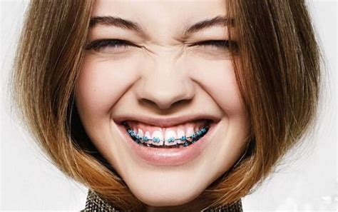 Зачем нужны брекеты и как их выбрать