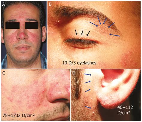 Rosacea and Demodicosis: Little-known Diagnostic Signs and Symptoms ...