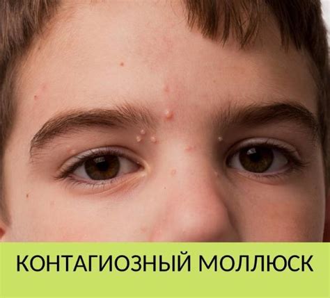 Медицинский ликбез. Контагиозный моллюск