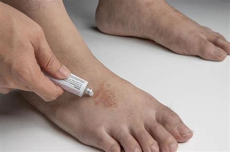 Rekomendasi Obat Salep untuk Kurap di Apotek dengan Harga Terbaru ...