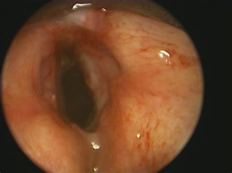 anterior glottic web iowa head  neck protocols carver college