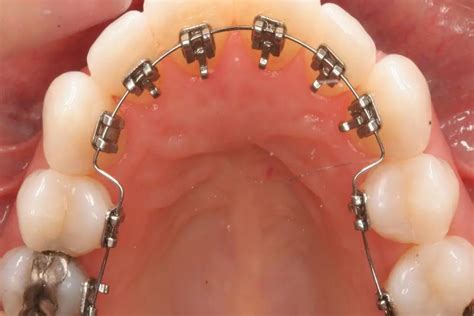 Lingual - Clinica Dental Sonrisa Segura