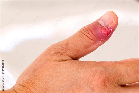 paronychia swollen finger  fingernail bed inflammation due