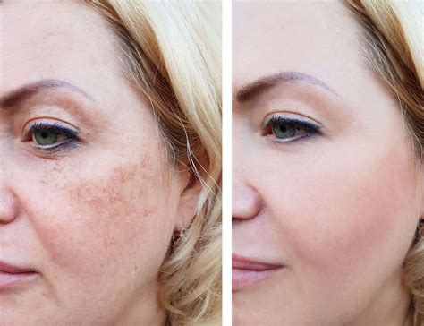 How Long After Sun Exposure Do Freckles Appear at Jacob Salter blog