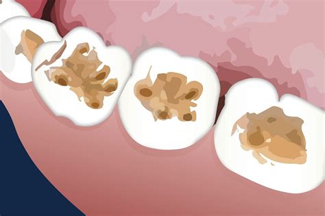 cavities     dentists  newmarket