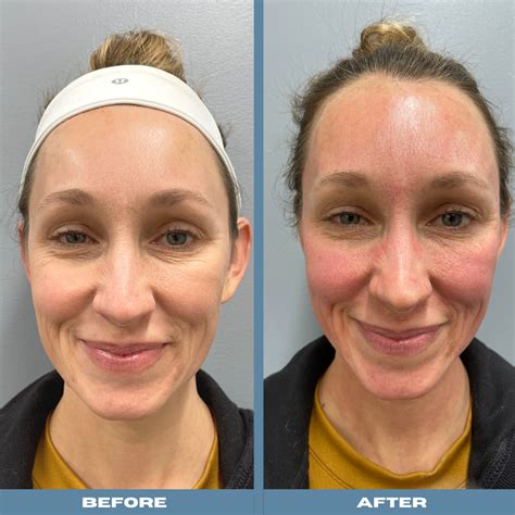 microneedling real life    experience cornerstone