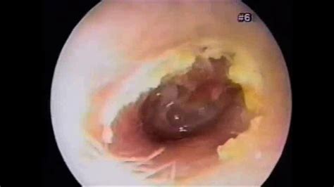 ear immunity  cdc clinical study rochester regional health