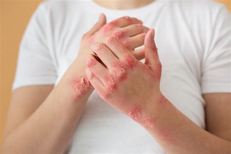 Psorijaza - simptomi, dijagnosticiranje i liječenje psorijaze