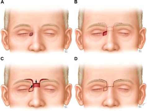 glabellar flaps  nasal reconstruction facial plastic surgery clinics