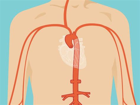 Ascending Aortic Aneurysm: Repair, Surgery, and Size Criteria