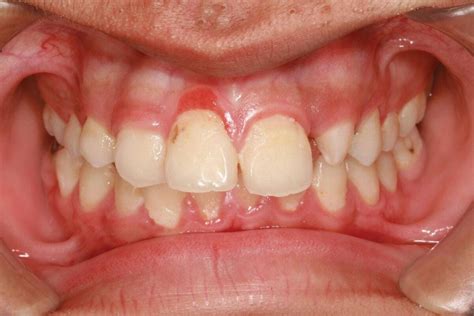 how to treat inflamed gums at home