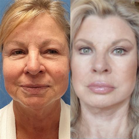 Подтяжка лица: фотографии до и после - Nordesthetics Clinic