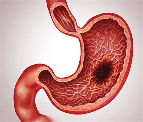 gastric cancer surgery dr saurabh kalia