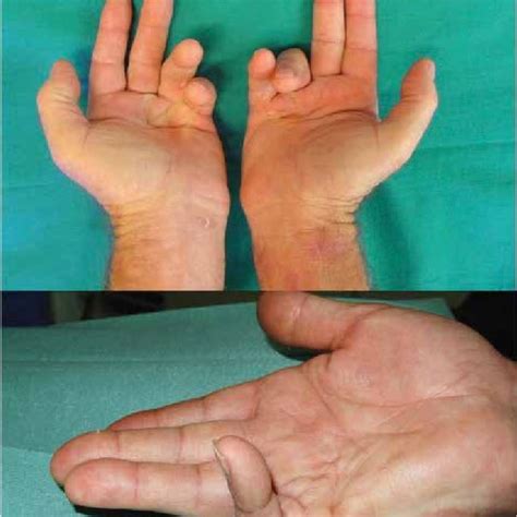 closure of the wounds may not be uneventful. MCP and PIP joint ...