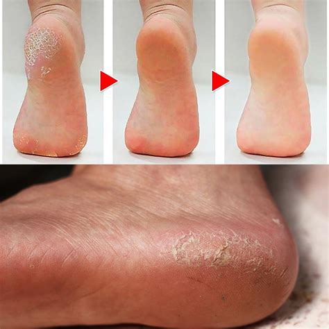 how to get rid of calluses on big toe 4