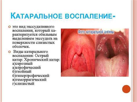 ВОСПАЛЕНИЕ Подготовила: Сборец М. А. ВОСПАЛЕНИЕ