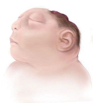 Anencephaly: is a congenital defect where in the hemispheres of the ...