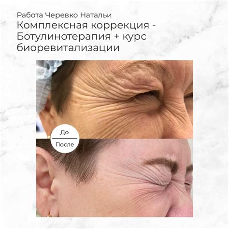 Ботулинотерапия - Услуги