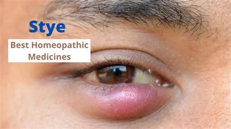 homeopathy  stye  symptoms  medicines