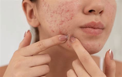 Beware the "death triangle": Dangers of popping pimples explained