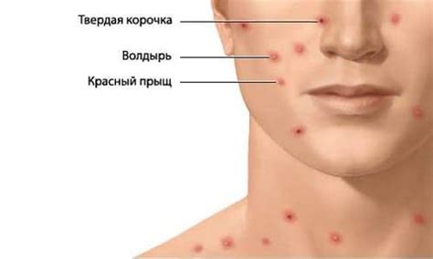 Ветрянка у взрослых симптомы и лечение