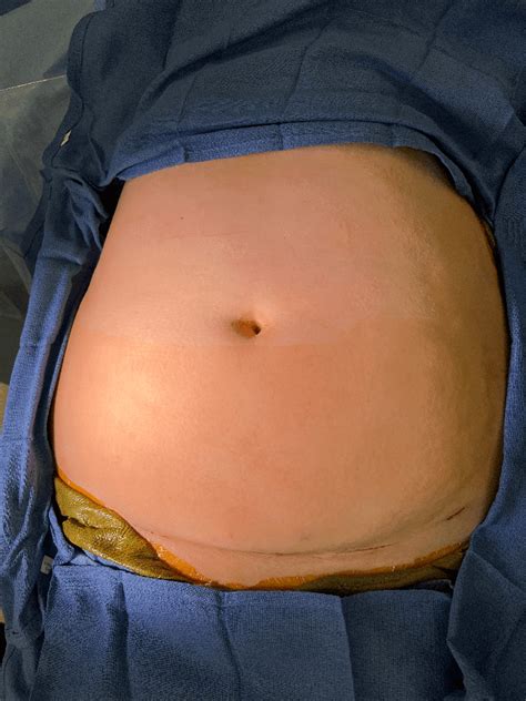 Gallbladder Surgery