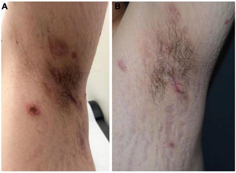 Acne pyoderma - what is it? Causes, symptoms, treatment - Healthy Food