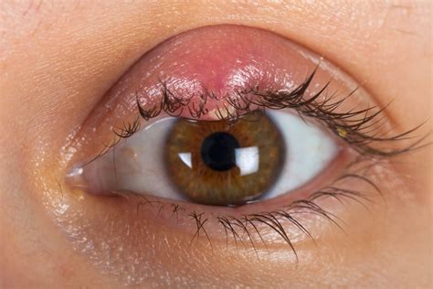 stye  eyelid
