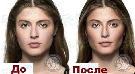 Что такое комки биша на лице фото до и после