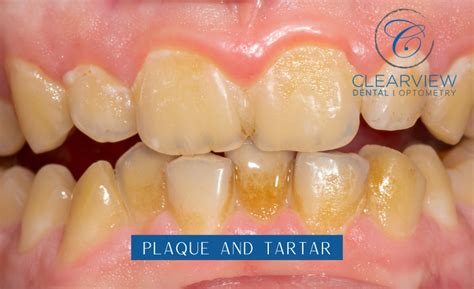 plaque pictures  teeth