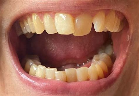 The patient's perfect oral hygiene