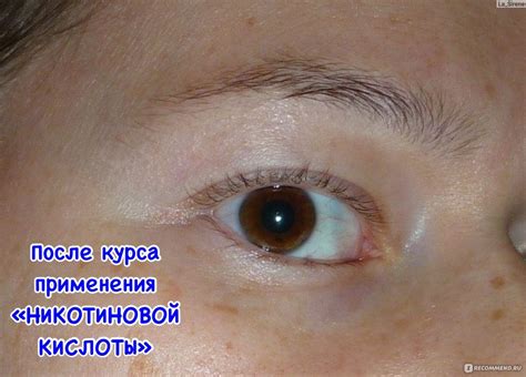 Брови после никотиновой кислоты - 55 фото
