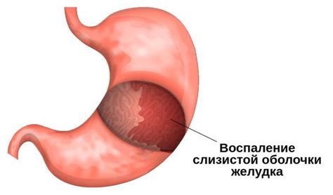 что такое гастрит и его симптомы и как его лечить