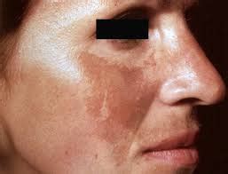 Acne Detection Object Detection Dataset by AI Project SIB