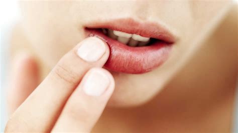 ¿Qué son las Llagas y Por Qué Salen? - Nart Clínica Dental