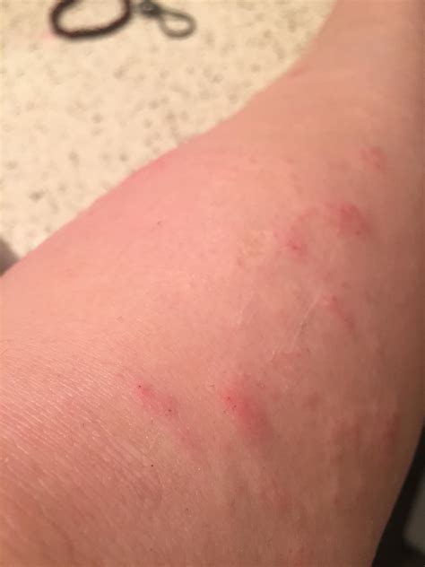 Itchy, Burning Rash on both Shins. What is it? : r/Dermatology