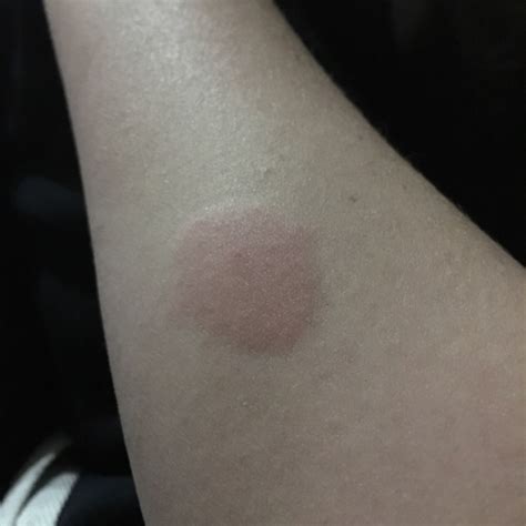 how to know tb test is positive