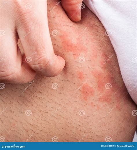 Eczema groin stock photo. Image of dermatology, illness - 51330452