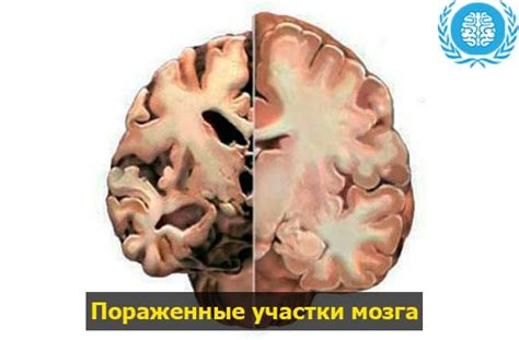 Глиоз головного мозга — Диагностика и методы лечения, симптомы, советы ...