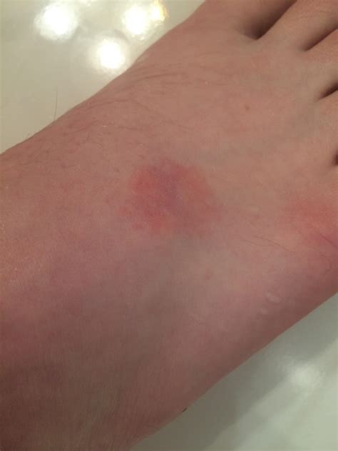Discover What Do It Mean When Your Foot Itch According To Common Medical Explanations 2
