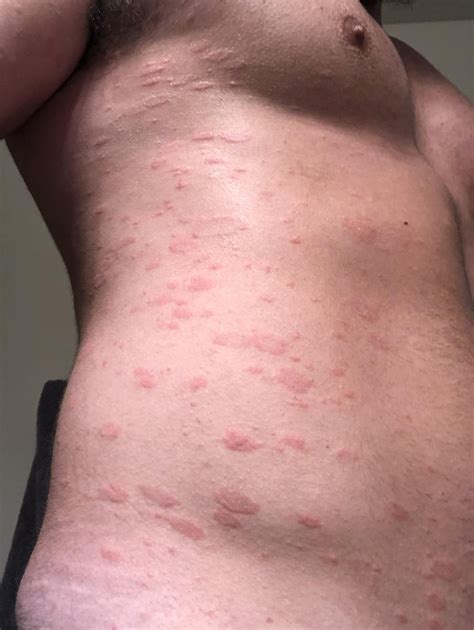 Matchless Tips About How To Get Rid Of Pityriasis Rosea - Welfareburn20