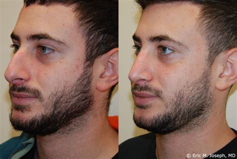men nose job