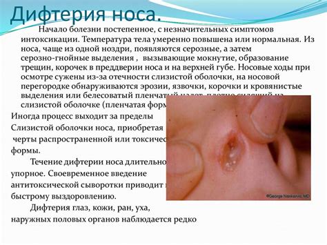 Дифтерия коринобактерия. Микробиология - презентация онлайн